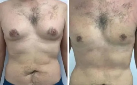 Redefine Your Physique with the Best Gynecomastia Surgeon in Dubai