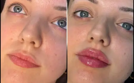 Best Doctors in dubai for Anti-Aging Fillers: Look Younger Instantly