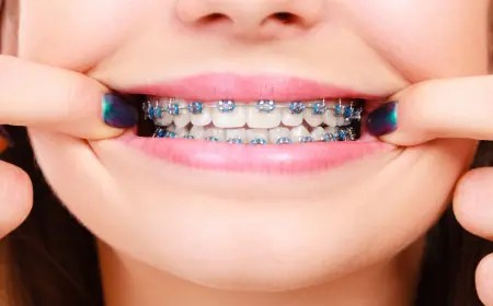 Color Bands for Braces: How to Let Kids Express Themselves