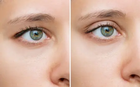 Can Eyelid Surgery Fix Excess Skin After Weight Loss?