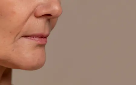 Is Sculptra Effective in Treating Marionette Lines?