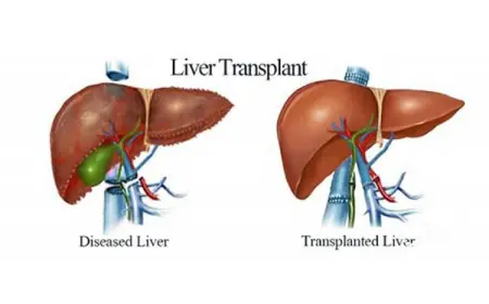 How Much Does a Liver Transplant Cost in Singapore?