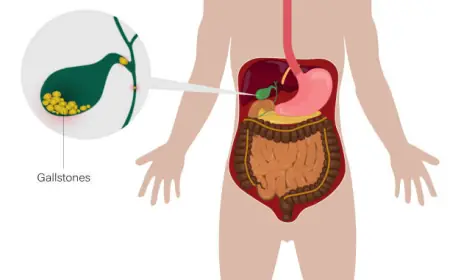 Gallstones Singapore: Early Diagnosis and Prevention Tips
