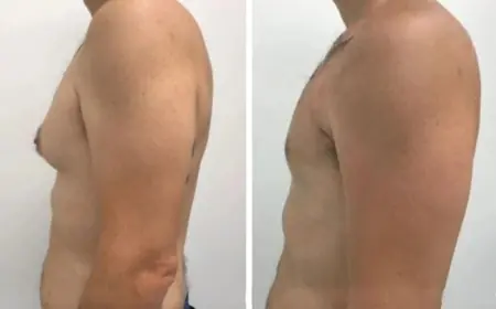 Looking Your Best with Gynecomastia in Dubai