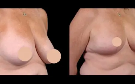 Average Vs. Elite Clinic Costs for Breast Reduction in Dubai