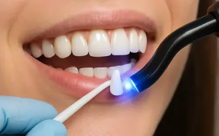 How Long Does Dental Bonding Last? What You Should Know