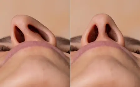 Can Rhinoplasty Make My Nose Smaller?