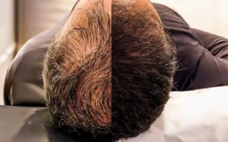 Hair Transplant in Islamabad – A Permanent Solution for Hair Loss