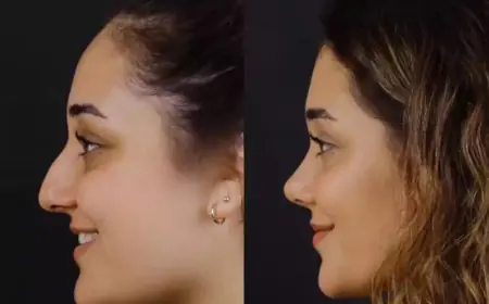 Best Rhinoplasty Surgeon in Dubai: Key Skills to Look For
