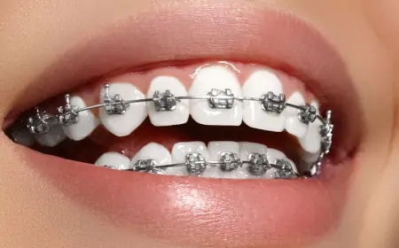 Orthodontic Retainers: Why They’re Essential After Braces