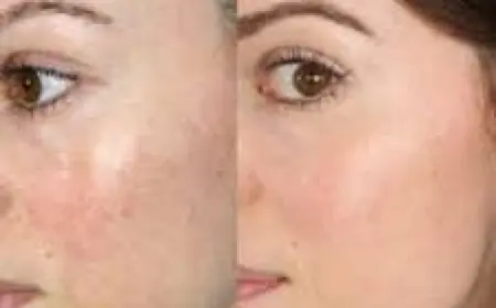 Microneedling Treatment in Islamabad – A Complete Skin Rejuvenation Guide