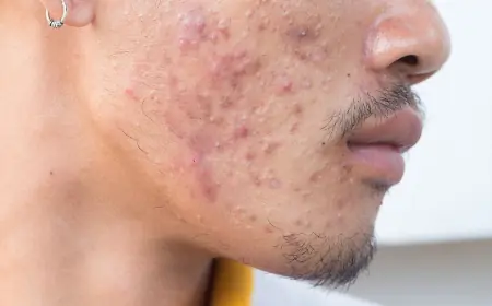 Can Pimples Treatments Be Tailored to Individual Needs?