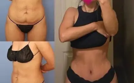 Tummy Tuck: Best Doctors in Dubai for Stunning Results