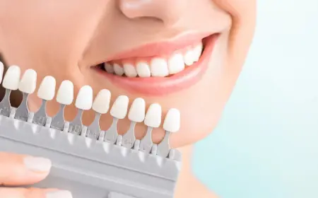 E-Max Veneers: The Perfect Blend of Strength and Aesthetics