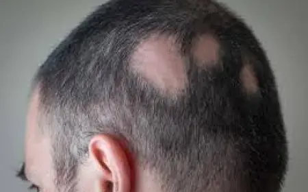 Alopecia Areata Treatment in Islamabad – Advanced Solutions for Hair Regrowth
