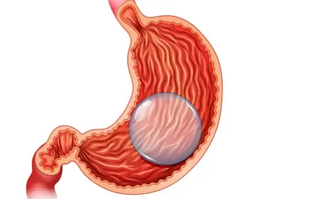 Gastric Balloon Placement Procedure