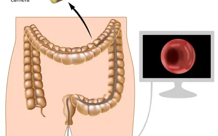 Colonoscopy Screening Singapore: A Guide to Preparation and Recovery