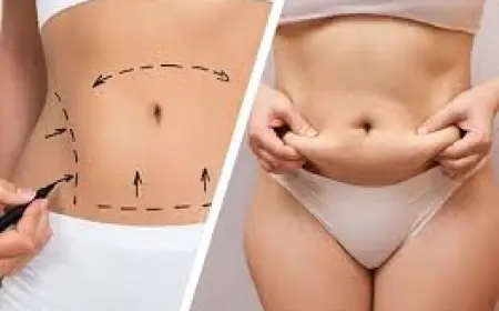 Abdominoplasty in Islamabad – Regain a Flat and Confident Abdomen