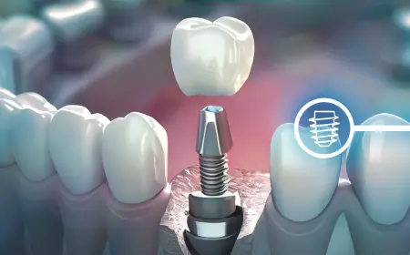 Common Myths About Dental Implants Debunked