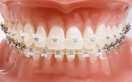 Modern Options for Straightening Your Teeth