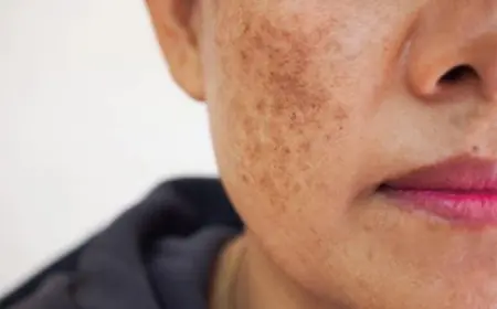 What Is the Price of Dermal Pigmentation Removal?