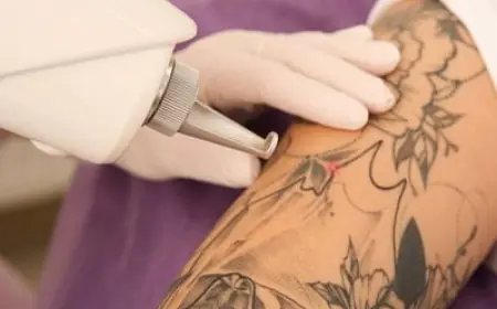 إزالة الوشم بالليزر بسرعة وفعالية