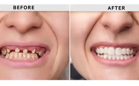 Trusted Dental Restorations for a Confident Smile