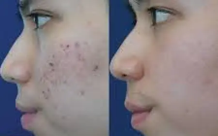 Acne Scars Treatment in Islamabad – Say Goodbye to Stubborn Marks