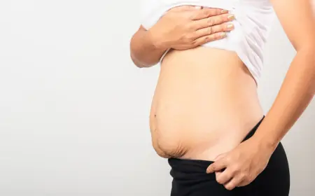 Can Tummy Tuck Surgery Fix Loose Skin After Weight Loss?