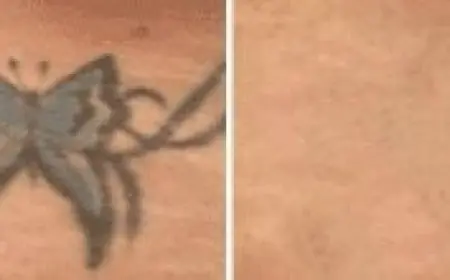 Can Old or Faded Tattoos Be Removed More Easily with Laser Tattoo Removal?