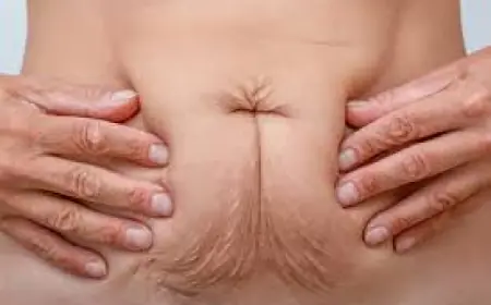 Can Tummy Tuck Surgery Fix Loose Skin After Weight Loss?