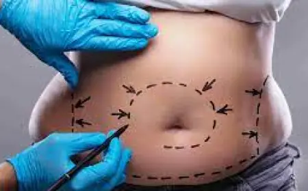 Is a Mini Tummy Tuck Suitable for Minor Belly Fat?