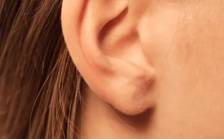 How Long Does Ear Plastic Surgery Take to Heal?
