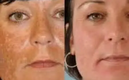 What to Expect from Melasma Treatment in Islamabad