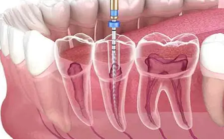 How to Save Money on Root Canal Treatment in Islamabad