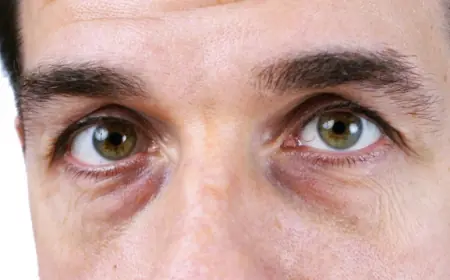 Can Dark Circles Treatment Work for Men Too?