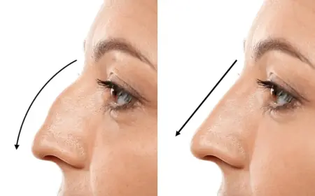 Before & After Rhinoplasty: Real Results That Inspire