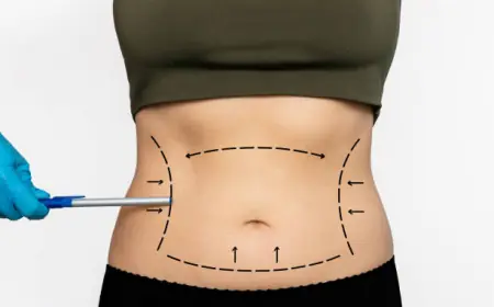 Patient Experiences: Real Stories of Lipo Abdominoplasty in Riyadh