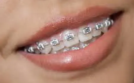 Painless & Reliable Dental Braces Treatment in Islamabad