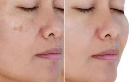 Complexion with Professional Skin Whitening Treatment in Islamabad