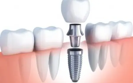 Missing Teeth? Get Dental Implants in Islamabad for a Natural Smile