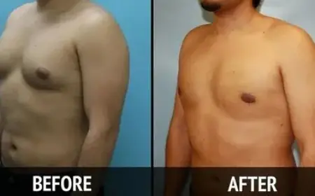 Regain Confidence with Advanced Gynecomastia Treatment in Islamabad