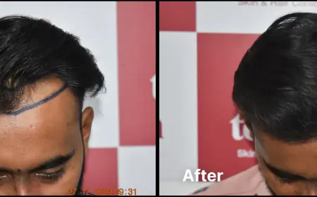 How To Find The Best Hair Transplant Clinic In Ahmedabad?