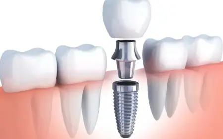 Achieving A Perfect Smile With Dental Implants In London, Ontario