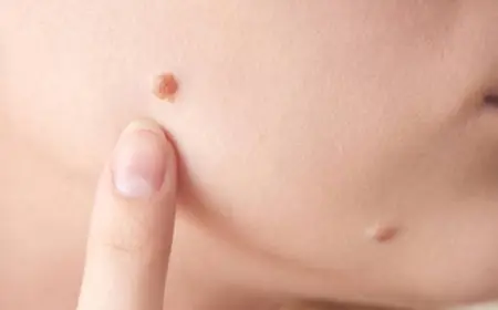 Skin Wart Removal Cost Based on Wart Duration