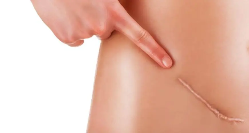 Laser Scar Removal Cost: Hidden Charges to Watch Out For
