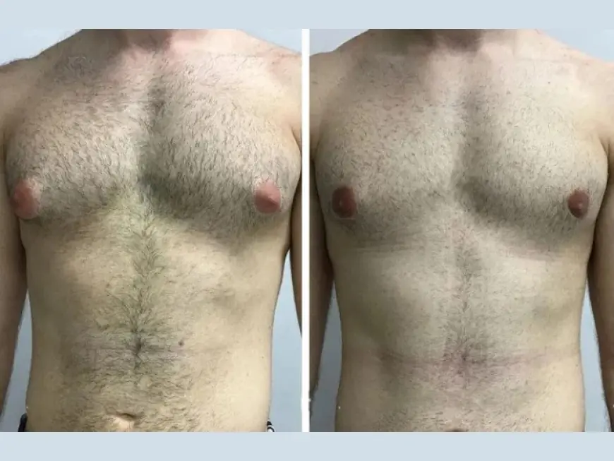 The Role of Ultrasound in Gynecomastia Surgery in Dubai