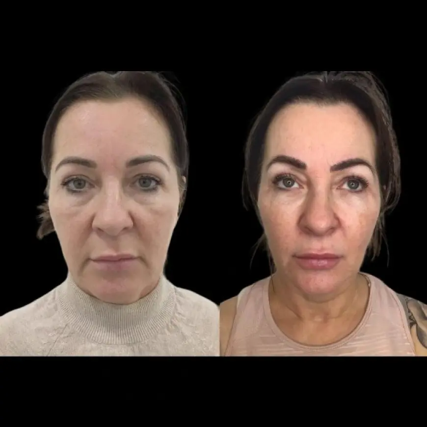 How Long Does Profhilo Last The Best Aesthetic Clinic in Dubai Answers