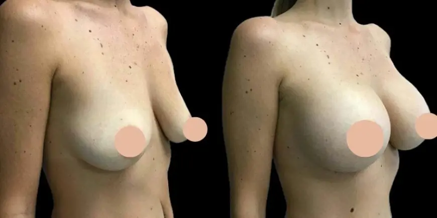 Breast Augmentation in Dubai for Different Body Types: What’s Right for You