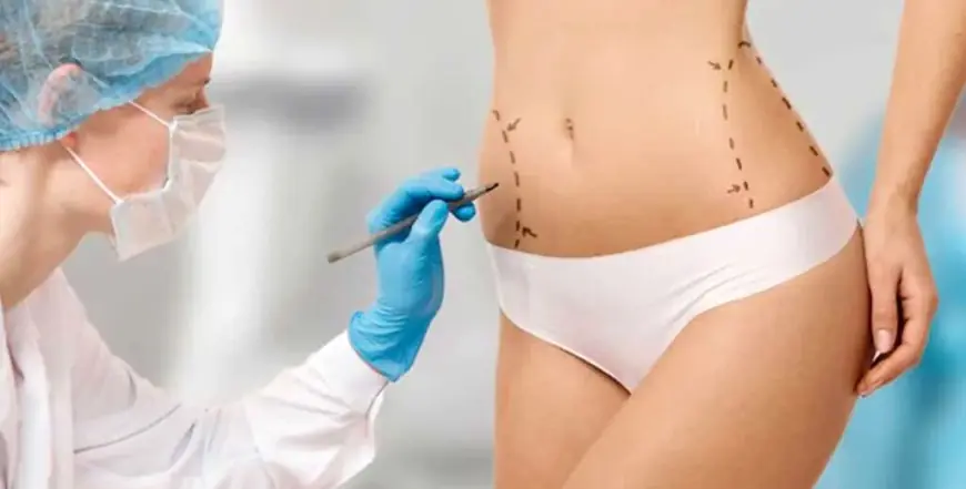 Liposuction Procedure in Islamabad: Step-by-Step Overview
